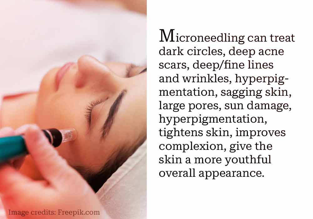 benefits-of-microneedling