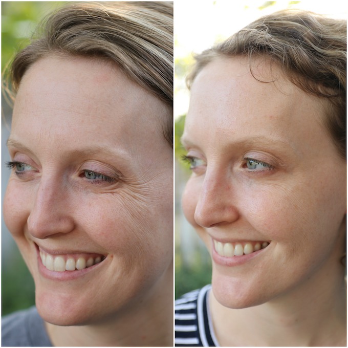 botox-before-after images