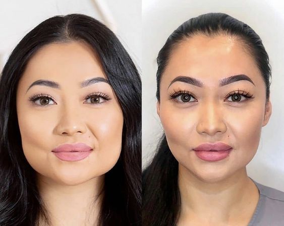 masseter botox before after photo
