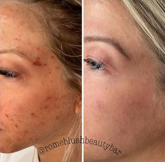 microchanneling before after images of a girl's face