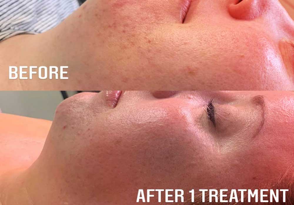 microchanneling-before-after image