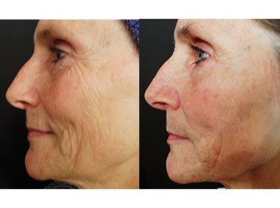 microchanneling-before-after-photo