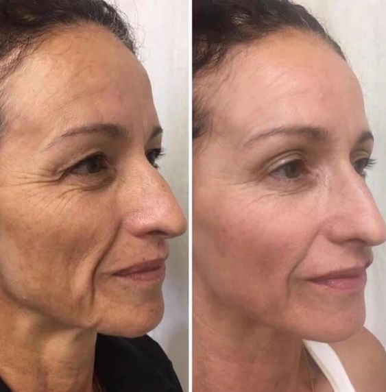 Microchanneling treatment photo