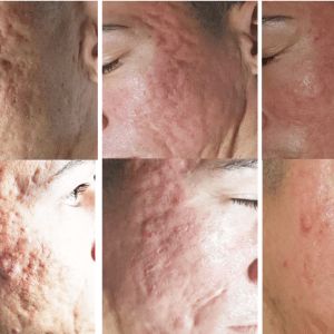 Microchanneling before and after picture