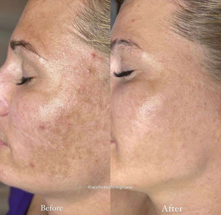 Microchanneling before after photo