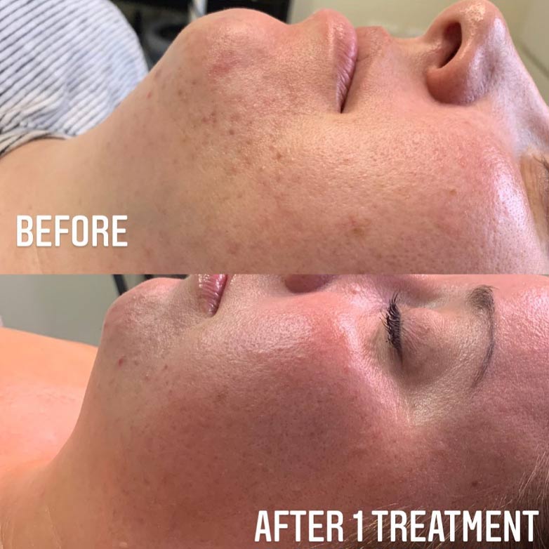 microchanneling-beforeafter