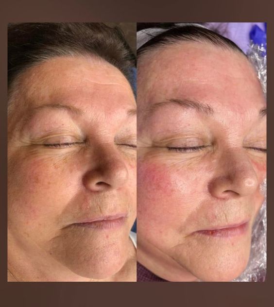 microchanneling treatment comparison