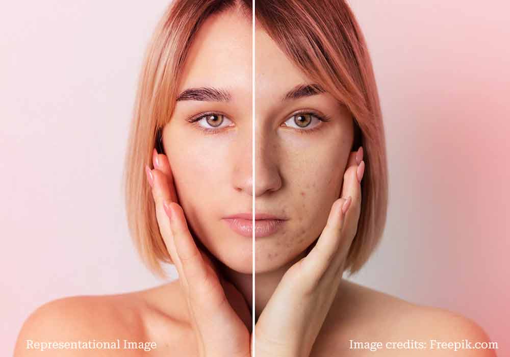 microneedling-before-after-image