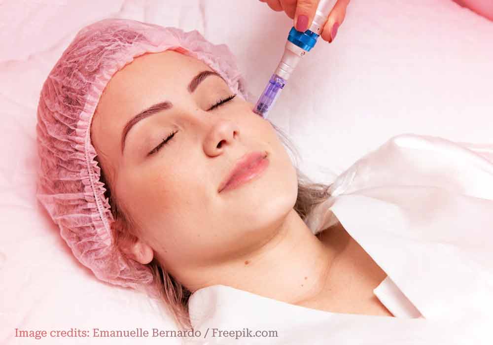 microneedling treatment