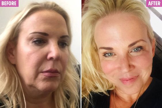 Resting bitch face before after image