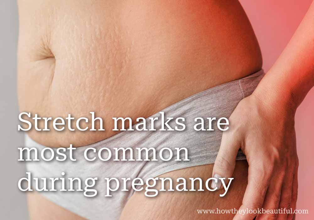 stretch-marks-during-pregnancy